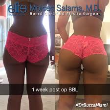 1 Week Post Op Bbl By Dr Moises Salama Beforeandafter Drbuttsmiami Salamafied Fattransfer Brazilian Buttlift Surgery Brazilian Buttlift Mommy Makeover