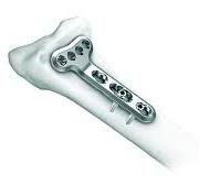 2.4 mm Variable Angle LCP™ Volar Extra-Articular Distal ...