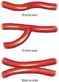 The part of the large bowel with cancer is removed, along with surrounding lymph nodes. Common Postoperative Anatomy That Requires Special Endoscopic Consideration Techniques In Gastrointestinal Endoscopy
