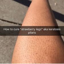 134 9k Likes 1 760 Comments Makeupgoals On Instagram How To Get Rid Of Strawberry Legs Swipe Strawberry Legs Exfoliate Legs Body Skin Care