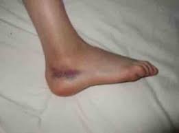 Ayakta Morarma Neden Olur Acil Servis