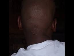 Acne on scalp occurs due to excessive oils or too much sebum released by sebaceous glands. How Laser Can Treat Black Men W Ingrowns On The Head Youtube