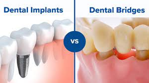 On average late and senile people tend to turn to the dentist for tooth. Does Dental Insurance Cover Implants Dental News Network