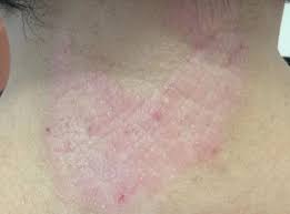 Image result for Lichen Simplex Chronicus