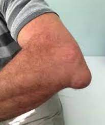 Slijmbeursontsteking Betekenis Engels