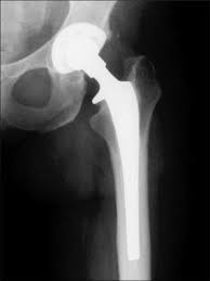 Image result for Hip XRay