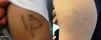 But a tattoo no longer has to be forever. Laser Tattoo Removal In New Jersey Soma Skin Laser