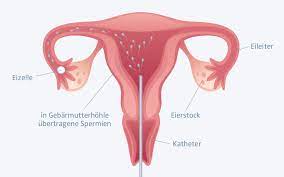Insemination In Munchen Kinderwunschzentrum An Der Oper