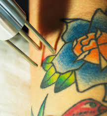 Established in 2019 as a tattoo removal focused business, precision laser has since expanded their services to include laser hair removal, pigmented lesion removal, acne treatment, and more. Laser Tattoo Removal Business Make Money With Tattoo Removal