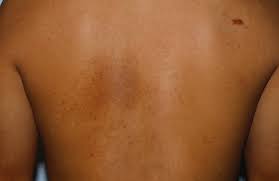 Image result for Notalgia Paresthetica