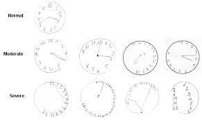 A score of 26 or over is considered to be normal. Clock Drawing Cognitive Test Should Be Done Routinely In Patients With High Blood Pressure