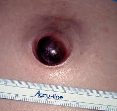 Image result for Umbilicus