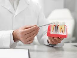 Transform Your Smile with Confidence The Ultimate Guide to Dental Implants  at Smiles at Richmond Hill – SmilesatRichmondHill