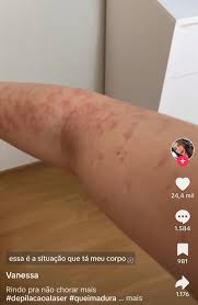 Jovem relata ter sofrido queimaduras no corpo após sessão de depilação a  laser | Atualidades | Vogue
