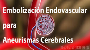 Debido a que un aneurisma cerebral intacto a menudo no causa ningún síntoma. Embolizacion Endovascular Para Aneurismas Cerebrales Alila Medical Media Espanol Youtube