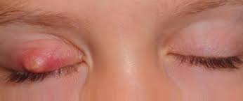 Assalamualaikum w.b.t dan salam sejahtera.video kali ini saya akan kongsikan 2 perkara iaitu :1. Kenal Pasti Punca Ketumbit Ini 5 Rawatan Mudah Menghilangkannya