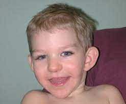 Study Catalogs Features Of Phelan Mcdermid Syndrome Spectrum Autism Research News