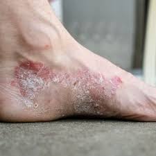 Image result for psoriasis