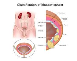 A procedure that makes a series of detailed pictures of areas inside the body. How We Diagnose Bladder Cancer Dana Farber Cancer Institute Boston Ma