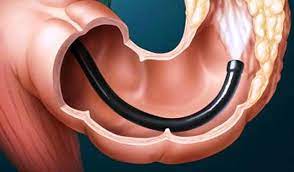 The tissue will be examined to determine if the growths. ØªÙ†Ø¸ÙŠØ± Ø§Ù„Ù‚ÙˆÙ„ÙˆÙ† Colonoscopy