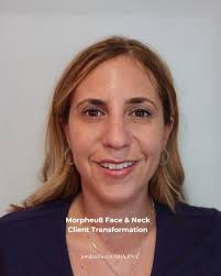 Best Morpheus 8 Treatment in Nyc