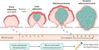 Colon cancer is the third most common cancer in men and women in the u.s. Does Early Metastatic Seeding Occur In Colorectal Cancer Nature Reviews Gastroenterology Hepatology