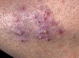 Ingrown Hair vs. Herpes: Symptoms, Causes, Treatment