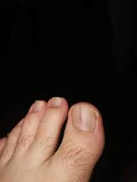 Grauer Schwarzer Langsstrich Zehnagel Gesundheit Und Medizin Medizin Nagelpilz