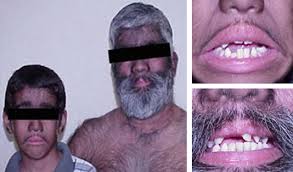 Image result for Hypertrichosis