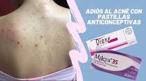 Como Elimine Mi Acne Con Pastillas Anticonceptivas Y Por Que Me Prohibieron Tomarlas Youtube
