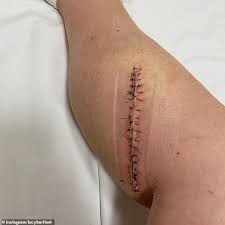 These energetic light waves can produce mutations in the dna of skin cells, which in turn can lead to skin cancer.in areas close to the equator, the incidence of cutaneous cancers is dramatically higher due to the increase in sun exposure. Student Diagnosed With Skin Cancer Twice After Spotting Mole On Leg Urges People To Get Checked