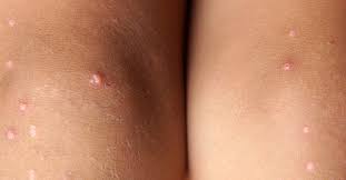 Apply aloe vera gel on the affected region. Pimples On Legs Causes And Treatment