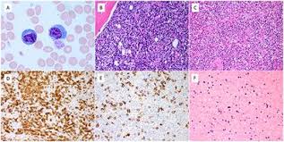 Up to 50% of patients with aitl present with skin manifestations. Frontiers Extreme Peripheral Blood Plasmacytosis Mimicking Plasma Cell Leukemia As A Presenting Feature Of Angioimmunoblastic T Cell Lymphoma Aitl Oncology