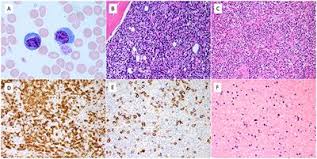 Angioimmunoblastic t cell lymphoma (aitl) presents in older patients and the median age at diagnosis is approximately 60. Frontiers Extreme Peripheral Blood Plasmacytosis Mimicking Plasma Cell Leukemia As A Presenting Feature Of Angioimmunoblastic T Cell Lymphoma Aitl Oncology
