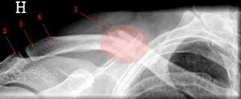 Brudd fra en religiøs gruppe kan være vanskelig. Kragebeinsbrudd Komplikasjoner Nhi No