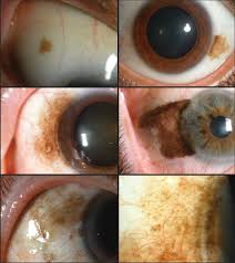 Image result for melanosis sclera