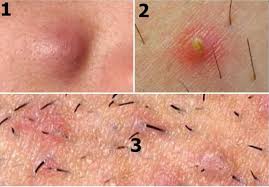 Sometimes they just look like small red pimples with no discharge, while other times they may be filled with yellow pus and blood or cause large bumps or lumps under the skin can be hidden under the skin. Ingrown Armpit Hair Causes Symptom And Removal Strong Hair