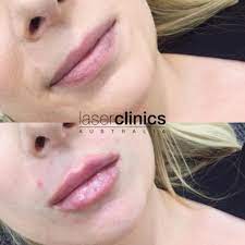 We understand the frustration of constant shaving, nicks from the razor, stubble, and bumps can cause, laser. Toowong Laser Clinics Australia