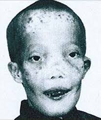 Roy “Rocky” Dennis Roy Dennis was an American teenager who had  craniodiaphyseal dysplasia (CDD), an extremely rare bone disorder. Despite  his eyesight limitations, hearing problems, and the painful headaches he  endured, Dennis