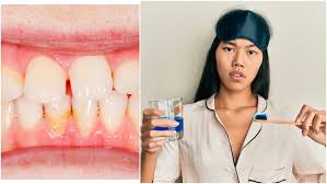 Maybe you would like to learn more about one of these? Berbeda Dengan Karang Gigi Ini 6 Cara Mudah Menghilangkan Plak Gigi Mumpung Belum Mengeras