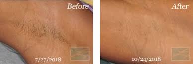 Avoid hot showers, saunas or any form of working out for 24 hours post. Laser Hair Removal New Orleans Splendor X Treatment