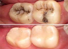 د حاتم البيطار Dental Fillings Dental Composite Dental