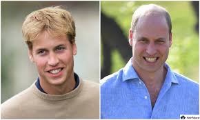 Prince Harry Hair Transplant | A Royal ...