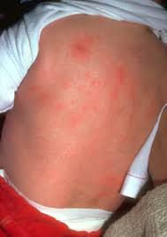 Image result for scabies human children
