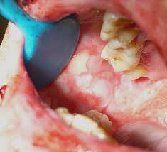 Image result for Erythema Multiforme Major