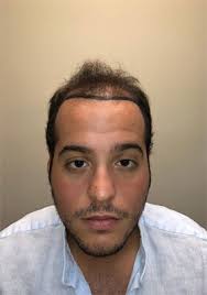 Hair Transplant Surgery For Men And Women in Maryland Harford Coldstream