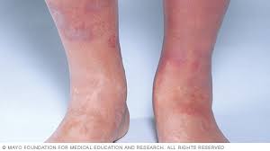 Image result for Stasis Dermatitis
