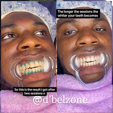 How Does Teeth Whitening Work at A Med Spa