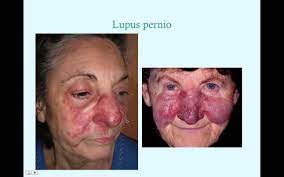 It is classified as either acute or chronic; Sarcoidosis Crash Medical Review Series Youtube