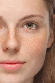 Image result for Melasma